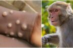 آنچه باید درباره ویروس “آبله میمون” بدانید